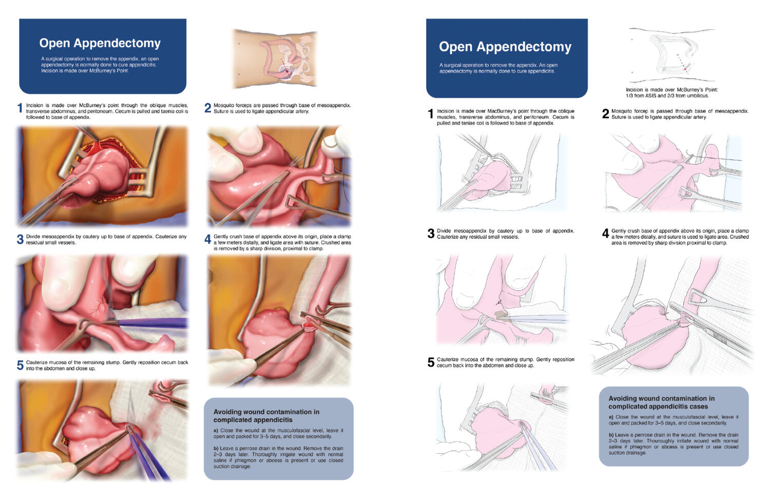 Open Appendectomy – Adobe Illustrator, Adobe Photoshop