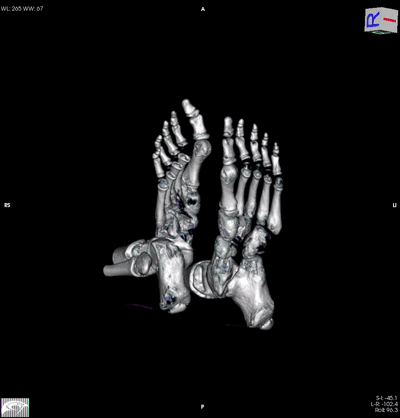 Foot MRI – Horos