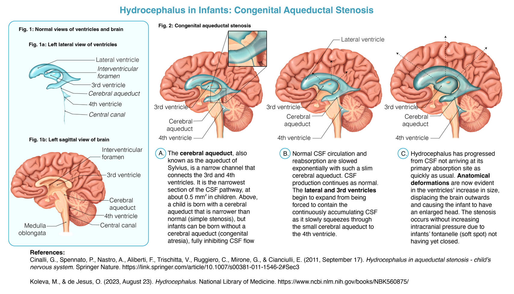 Hydrocephalus – Procreate, Adobe Illustrator