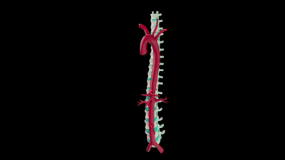 Aortic Aneurysm – Autodesk Maya, Adobe After Effects – Small clip from a 44 second video. Click for full video.